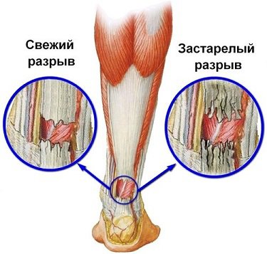 Лечение гематомы на ноге