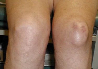 Лечим артроз коленного сустава в домашних условиях