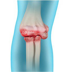 3. fokú deformáló arthrosis enyhíti a térd fájdalmát otthon